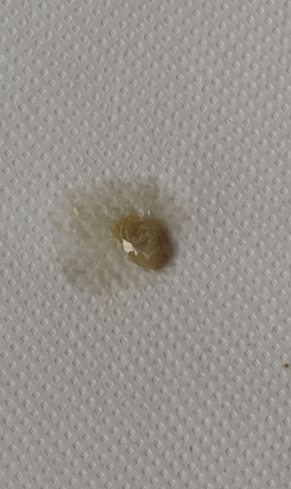 Feci voluminose